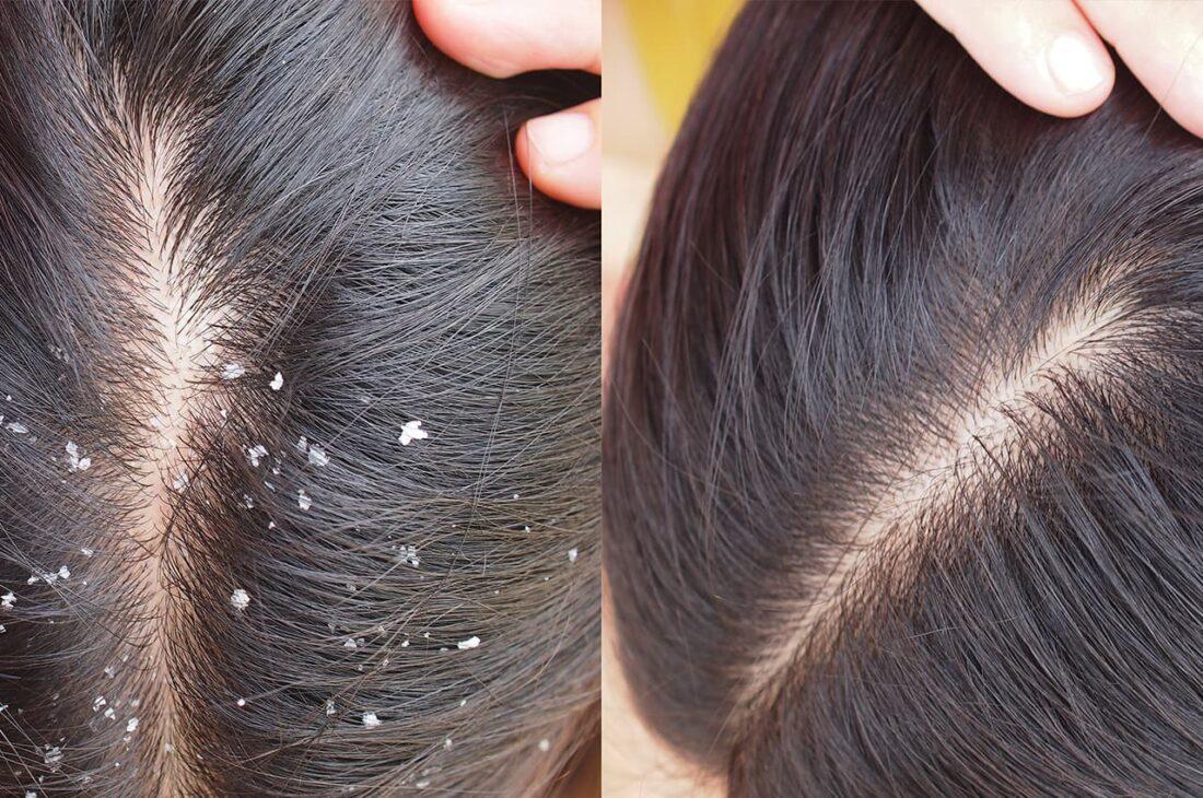 Hilfe bei schuppiger Kopfhaut Ursache, Therapie & Pflege